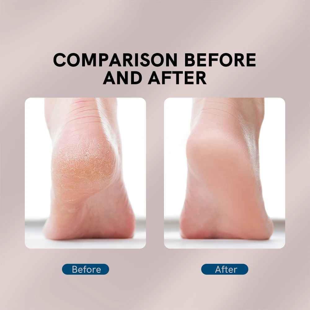 Electric Pedicure Foot Callus Remover