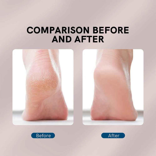 Electric Pedicure Foot Callus Remover